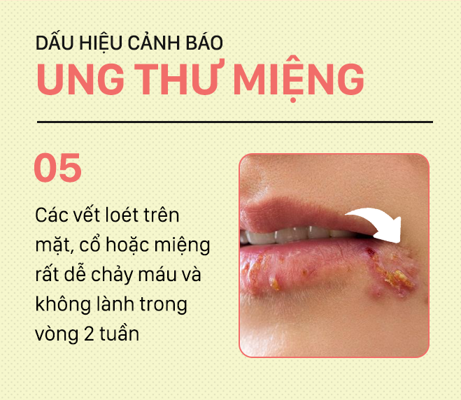 Đừng nhầm lẫn với bệnh ở miệng, đây là những dấu hiệu cảnh báo ung thư mà bạn nên nhớ-5
