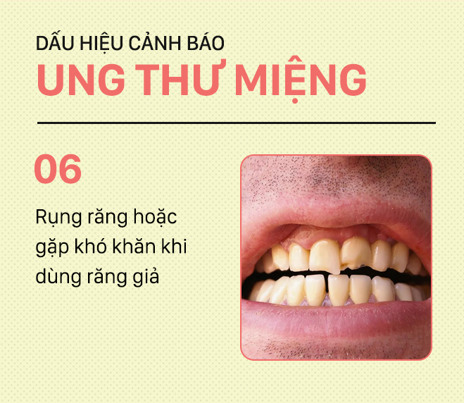 Đừng nhầm lẫn với bệnh ở miệng, đây là những dấu hiệu cảnh báo ung thư mà bạn nên nhớ-6