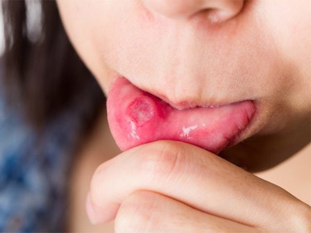 Nhiệt miệng, lở miệng mùa nóng, ăn gì mau hết?