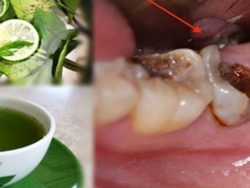 Ngậm nước lá chanh đun đặc – “Bài thuốc” trị sâu răng, viêm lợi, hôi miệng hiệu quả đến 90%