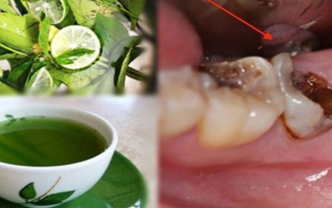 Ngậm nước lá chanh đun đặc – Bài thuốc” trị sâu răng, viêm lợi, hôi miệng hiệu quả đến 90%-1