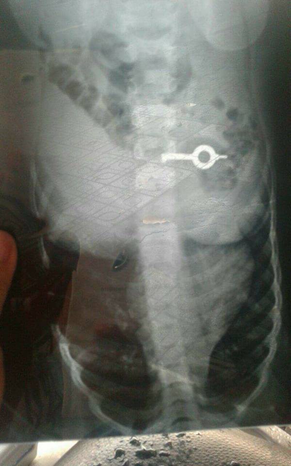 Lấy thành công chiếc chìa khóa trong bụng bé trai 5 tuổi mà không cần phẫu thuật-1