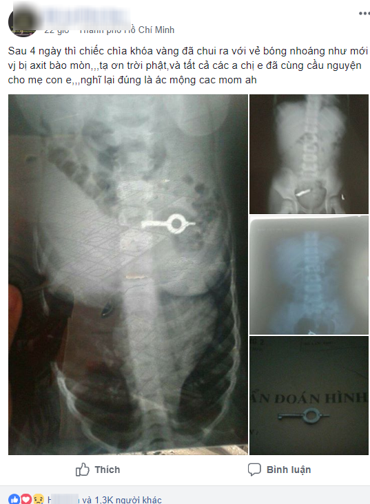 Lấy thành công chiếc chìa khóa trong bụng bé trai 5 tuổi mà không cần phẫu thuật-2