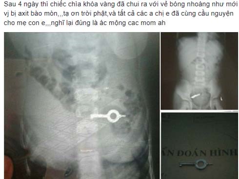 Lấy thành công chiếc chìa khóa trong bụng bé trai 5 tuổi mà không cần phẫu thuật