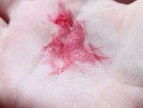 Ung thư phổi là bệnh có tiên lượng xấu: Chuyên gia chỉ rõ những dấu hiệu của bệnh