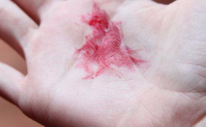 Ung thư phổi là bệnh có tiên lượng xấu: Chuyên gia chỉ rõ những dấu hiệu của bệnh-2