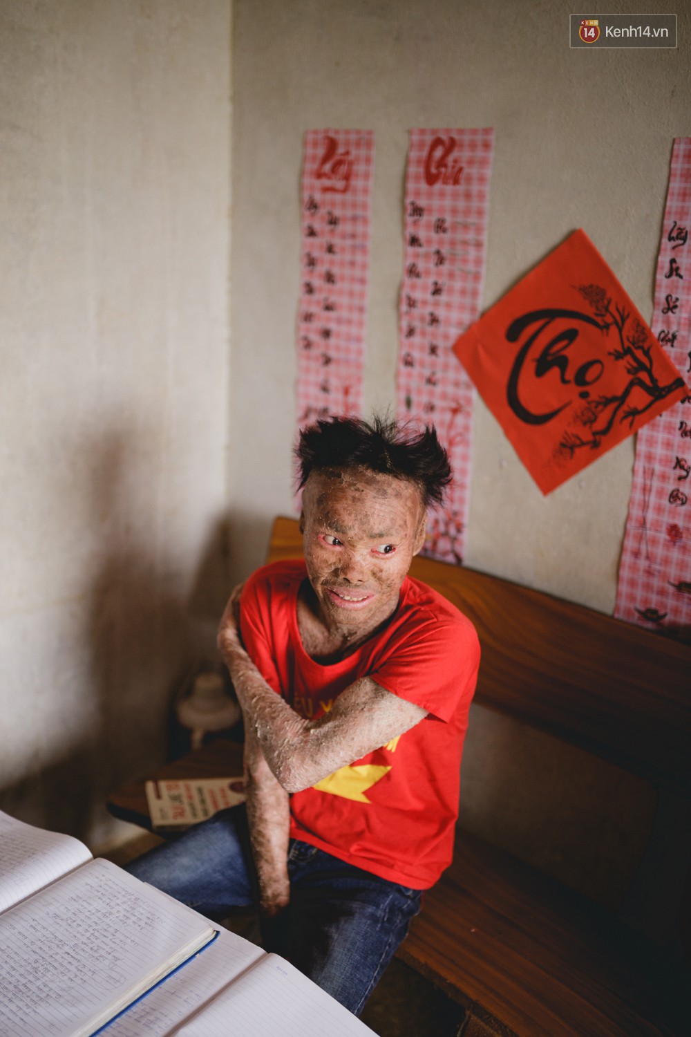 Chàng trai người cá lạc quan ở Hà Nội: Nhìn thấy bộ dạng của mình, nhiều người hỏi sao không chết đi, sống để làm gì?-12