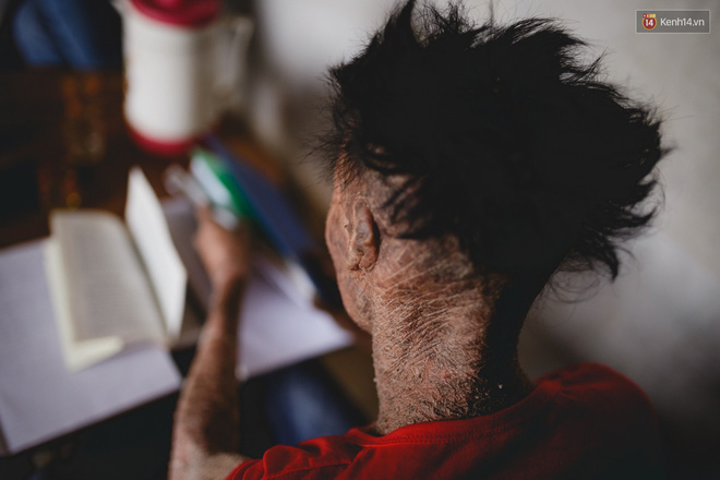 Chàng trai người cá lạc quan ở Hà Nội: Nhìn thấy bộ dạng của mình, nhiều người hỏi sao không chết đi, sống để làm gì?-9