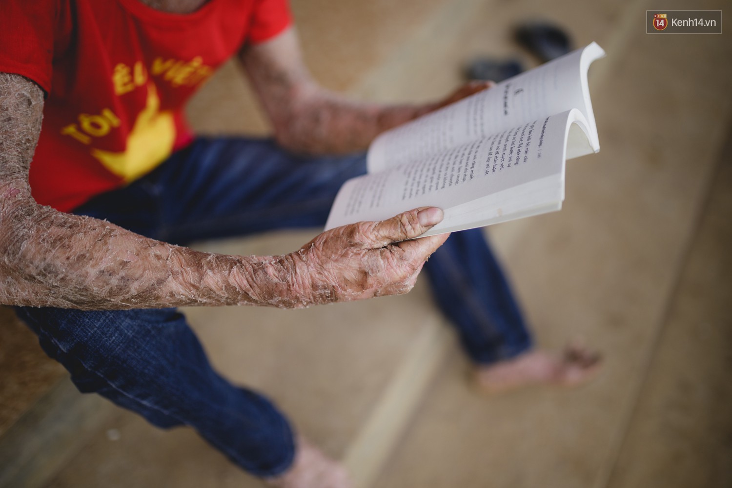 Chàng trai người cá lạc quan ở Hà Nội: Nhìn thấy bộ dạng của mình, nhiều người hỏi sao không chết đi, sống để làm gì?-6