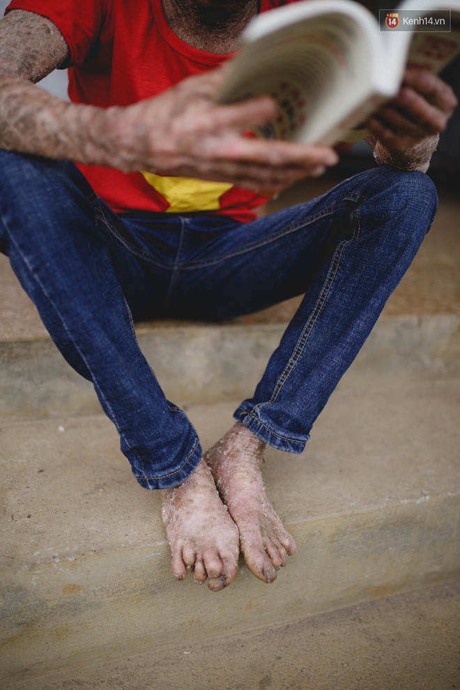 Chàng trai người cá lạc quan ở Hà Nội: Nhìn thấy bộ dạng của mình, nhiều người hỏi sao không chết đi, sống để làm gì?-7