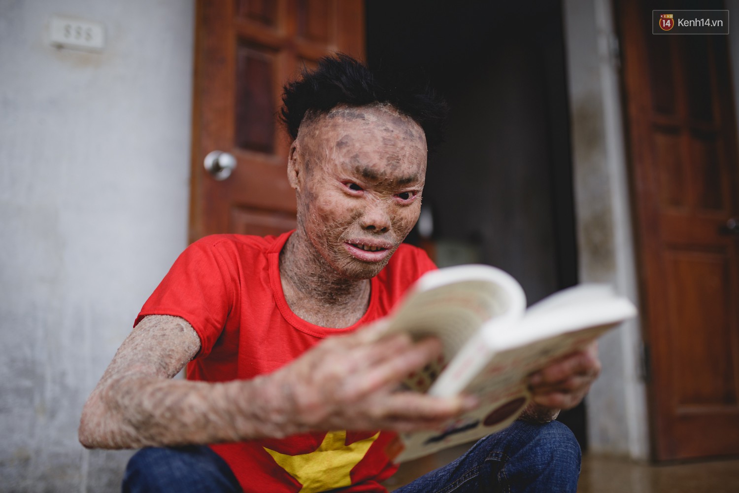Chàng trai người cá lạc quan ở Hà Nội: Nhìn thấy bộ dạng của mình, nhiều người hỏi sao không chết đi, sống để làm gì?-14