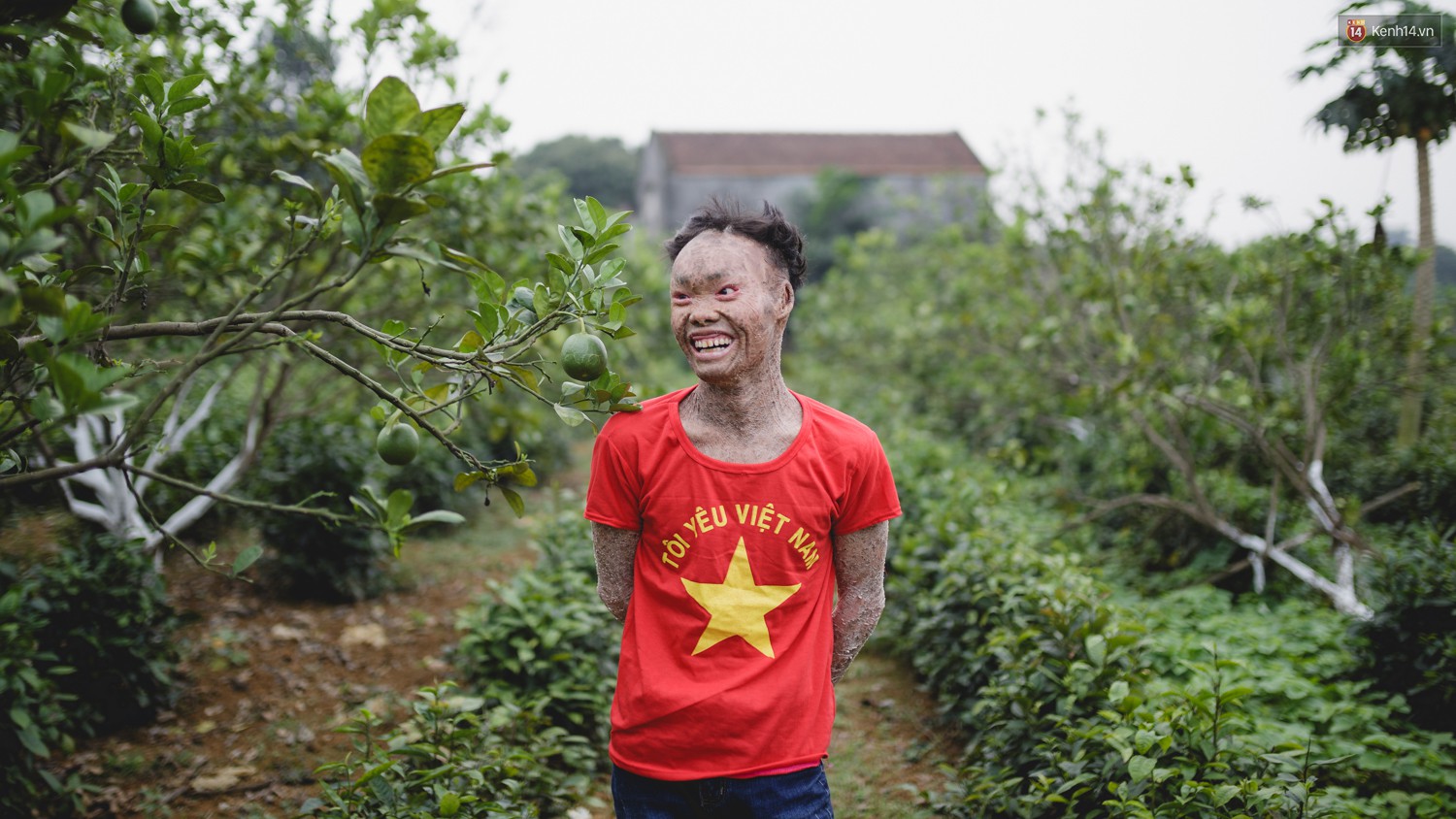 Chàng trai người cá lạc quan ở Hà Nội: Nhìn thấy bộ dạng của mình, nhiều người hỏi sao không chết đi, sống để làm gì?-15