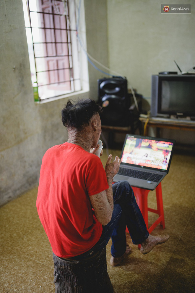 Chàng trai người cá lạc quan ở Hà Nội: Nhìn thấy bộ dạng của mình, nhiều người hỏi sao không chết đi, sống để làm gì?-5