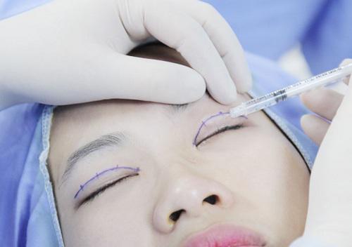 Chi tiền và mạo hiểm dao kéo nhưng bạn có biết nhấn mí kéo dài được bao lâu không?-2