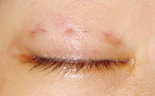 Chi tiền và mạo hiểm dao kéo nhưng bạn có biết nhấn mí kéo dài được bao lâu không?-4