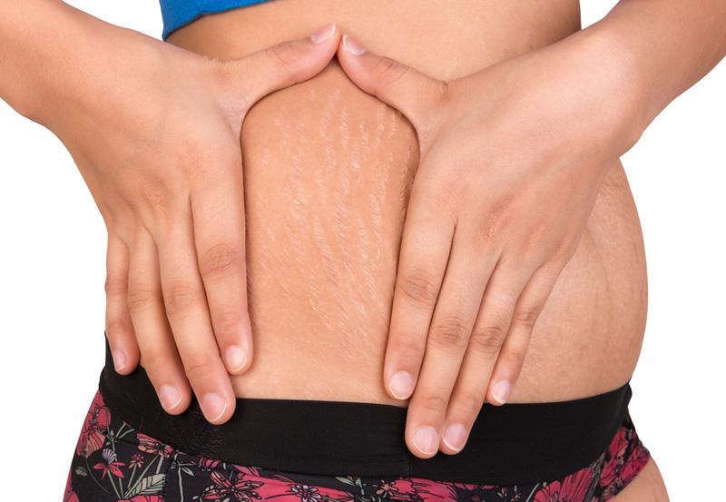 Mịn bụng tức thì nhờ 8 cách trị rạn da cho nàng tự tin vận bikini gợi cảm-1