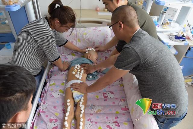 Bé trai 6 tuổi mỗi ngày phải tiêm 200 mũi vì một trận sốt cao 41,5 độ-1