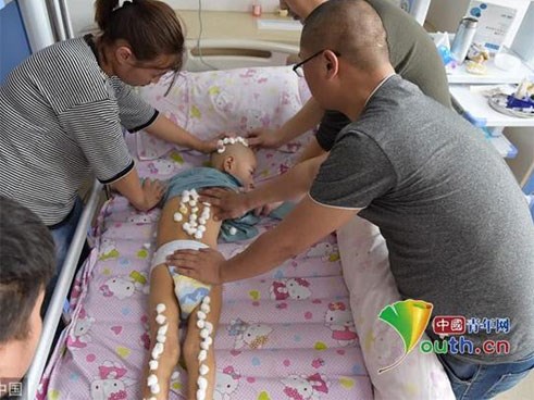 Bé trai 6 tuổi mỗi ngày phải tiêm 200 mũi vì một trận sốt cao 41,5 độ