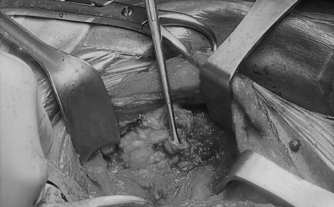 Báo động từ BV Nội tiết Trung ương: Liên tục phát hiện bệnh nhân mắc ung thư tuyến giáp-1