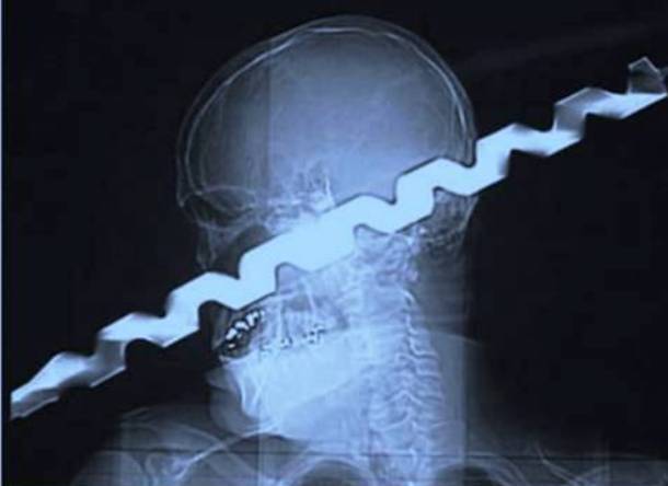 Những tấm phim chụp X-quang kinh dị nhất mà bạn từng thấy: bị mũi khoan, dao sắc hay đinh nhọn xuyên thủng hộp sọ vẫn sống sót-12