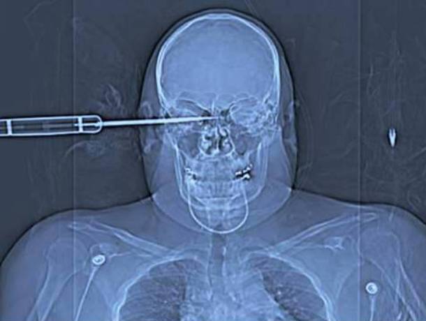 Những tấm phim chụp X-quang kinh dị nhất mà bạn từng thấy: bị mũi khoan, dao sắc hay đinh nhọn xuyên thủng hộp sọ vẫn sống sót-8