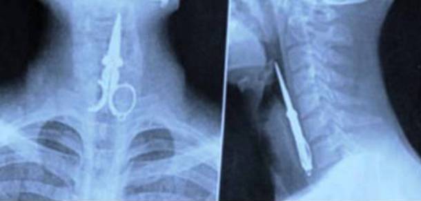 Những tấm phim chụp X-quang kinh dị nhất mà bạn từng thấy: bị mũi khoan, dao sắc hay đinh nhọn xuyên thủng hộp sọ vẫn sống sót-7
