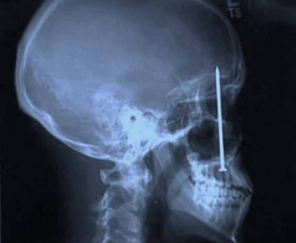 Những tấm phim chụp X-quang kinh dị nhất mà bạn từng thấy: bị mũi khoan, dao sắc hay đinh nhọn xuyên thủng hộp sọ vẫn sống sót-1