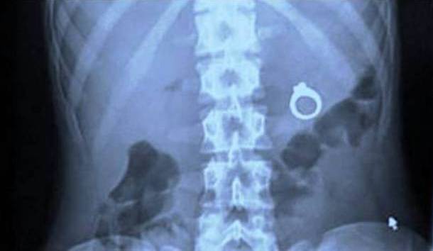 Những tấm phim chụp X-quang kinh dị nhất mà bạn từng thấy: bị mũi khoan, dao sắc hay đinh nhọn xuyên thủng hộp sọ vẫn sống sót-2