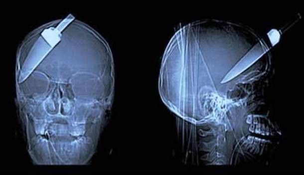 Những tấm phim chụp X-quang kinh dị nhất mà bạn từng thấy: bị mũi khoan, dao sắc hay đinh nhọn xuyên thủng hộp sọ vẫn sống sót-3