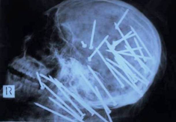 Những tấm phim chụp X-quang kinh dị nhất mà bạn từng thấy: bị mũi khoan, dao sắc hay đinh nhọn xuyên thủng hộp sọ vẫn sống sót-4