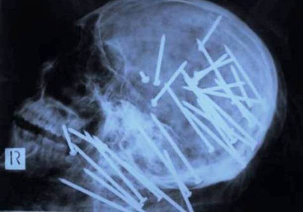 Những tấm phim chụp X-quang kinh dị nhất mà bạn từng thấy: bị mũi khoan, dao sắc hay đinh nhọn xuyên thủng hộp sọ vẫn sống sót-4