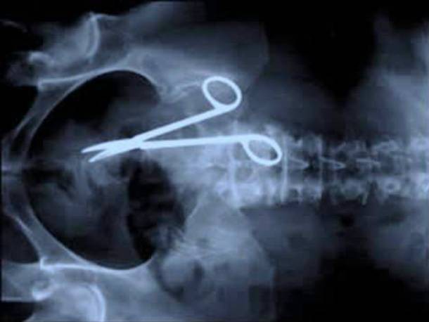 Những tấm phim chụp X-quang kinh dị nhất mà bạn từng thấy: bị mũi khoan, dao sắc hay đinh nhọn xuyên thủng hộp sọ vẫn sống sót-5