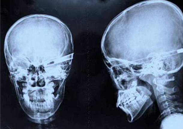 Những tấm phim chụp X-quang kinh dị nhất mà bạn từng thấy: bị mũi khoan, dao sắc hay đinh nhọn xuyên thủng hộp sọ vẫn sống sót-6