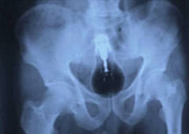 Những tấm phim chụp X-quang kinh dị nhất mà bạn từng thấy: bị mũi khoan, dao sắc hay đinh nhọn xuyên thủng hộp sọ vẫn sống sót-10