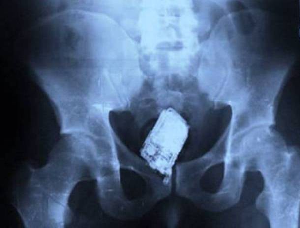 Những tấm phim chụp X-quang kinh dị nhất mà bạn từng thấy: bị mũi khoan, dao sắc hay đinh nhọn xuyên thủng hộp sọ vẫn sống sót-11