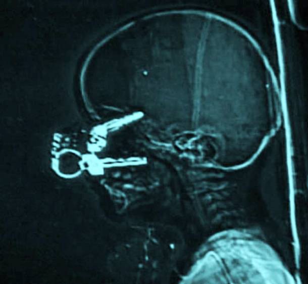 Những tấm phim chụp X-quang kinh dị nhất mà bạn từng thấy: bị mũi khoan, dao sắc hay đinh nhọn xuyên thủng hộp sọ vẫn sống sót-13
