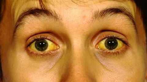 Những biểu hiện không ngờ của ung thư tụy dễ dàng bị bỏ qua-1