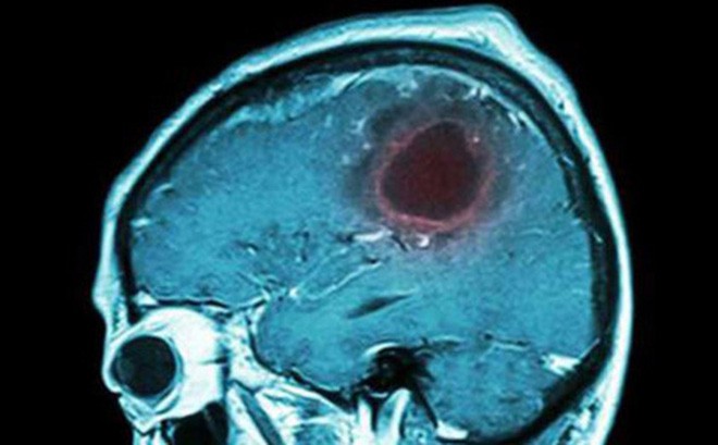 U não là nguyên nhân gây tử vong rất cao: Chuyên gia chỉ những dấu hiệu vàng cần đi khám-1