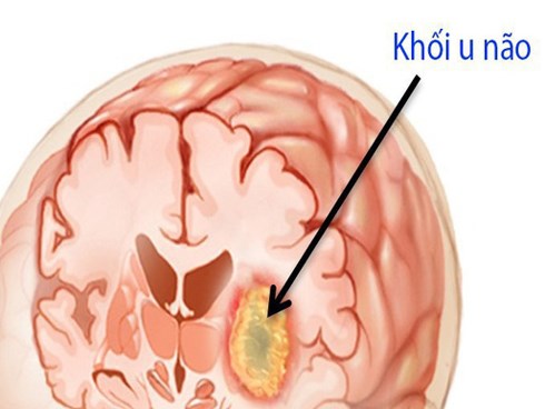 U não là nguyên nhân gây tử vong rất cao: Chuyên gia chỉ những dấu hiệu