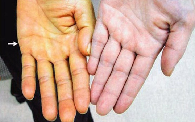 Viêm gan C tàn phá cơ thể như thế nào?-5