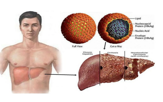 Viêm gan C tàn phá cơ thể như thế nào?-7