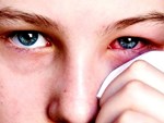 Phân biệt đau mắt đỏ và dị ứng thường gặp vào mùa xuân-4