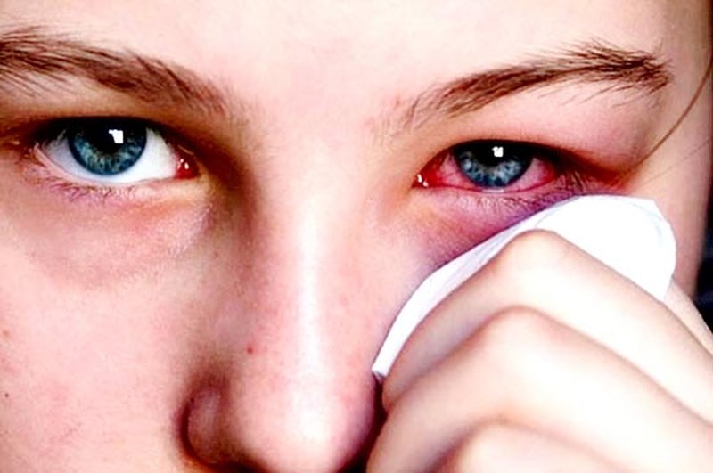 Bệnh đau mắt đỏ - một trong những bệnh cần tránh trong mùa hè-2
