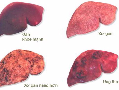 Xơ gan có thể dẫn đến ung thư gan: Đây là 4 nguyên tắc quan trọng giúp phòng ngừa hiệu quả