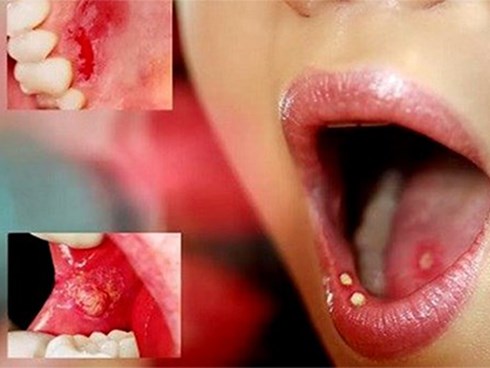 Đề cao cảnh giác với ung thư và bệnh tim nếu răng miệng xuất hiện những dấu hiệu này