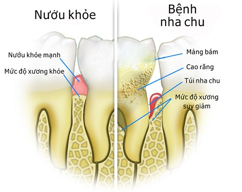 Đề cao cảnh giác với ung thư và bệnh tim nếu răng miệng xuất hiện những dấu hiệu này-2