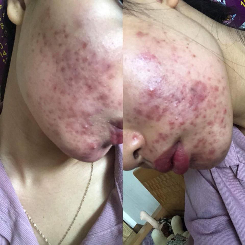 Dùng dầu tẩy trang sai cách, cô gái trẻ đắng lòng vì làn da bị tàn phá nặng nề bởi mụn-5