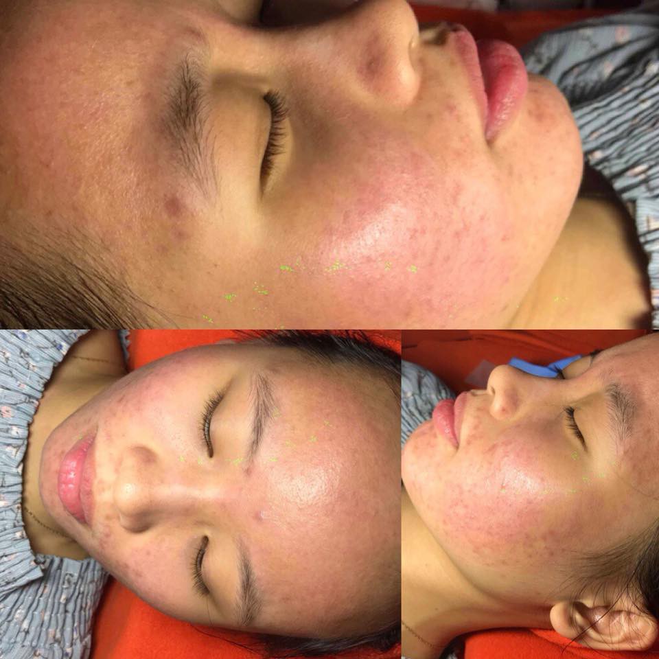 Dùng dầu tẩy trang sai cách, cô gái trẻ đắng lòng vì làn da bị tàn phá nặng nề bởi mụn-7