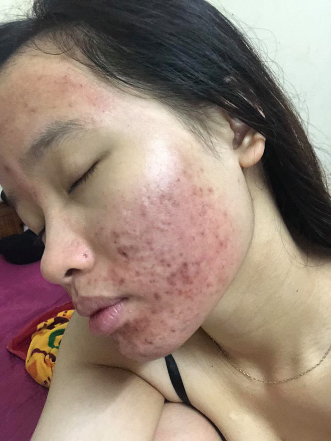 Dùng dầu tẩy trang sai cách, cô gái trẻ đắng lòng vì làn da bị tàn phá nặng nề bởi mụn-4