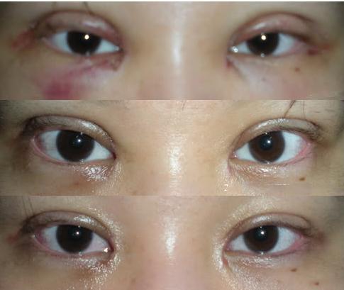 Không phải ai cũng biết nhấn mí mắt có hại không và cần lưu ý gì-5